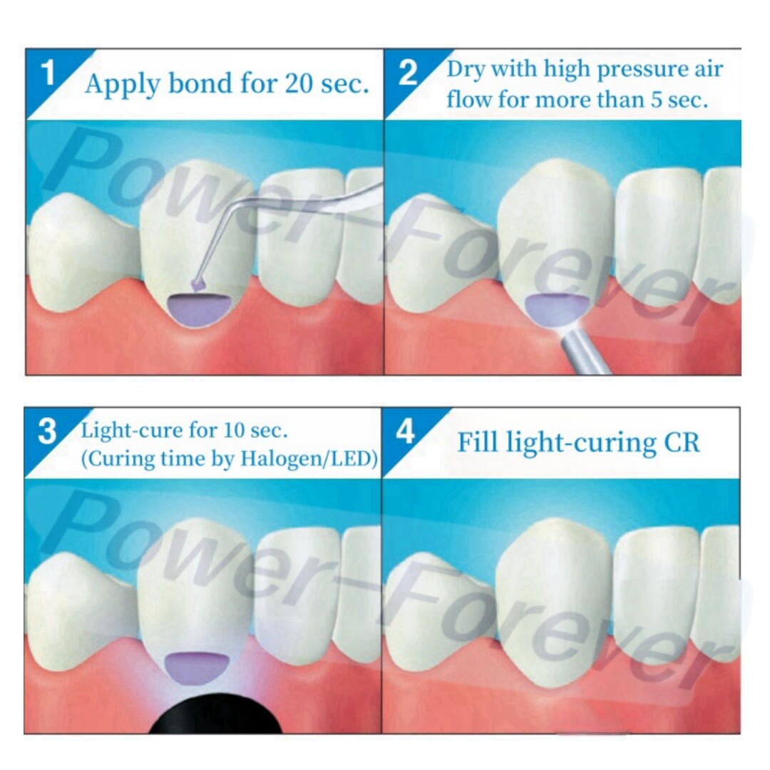 Kuraray Dental ClearFIL SE/S3 BOND Light-Curing Selfetching Primer Bond Adhesive