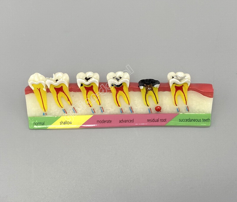 Dental Model Teeth Implant Restoration Bridge Teaching Study Medical Science