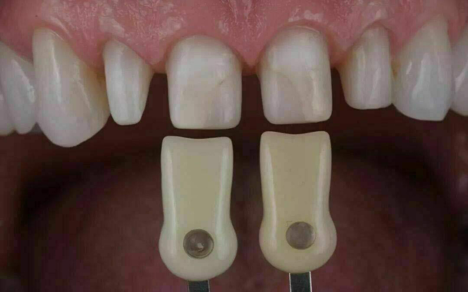 1Set Dental IPS Natural Die Material Shade Guide Ivoclar Vivadent ND1-9 Abutment