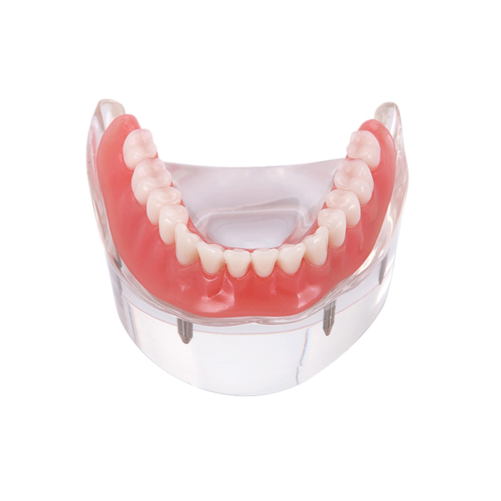 US Dental Model Clear Upper Lower 4 Implants Overdenture Restoration Removable