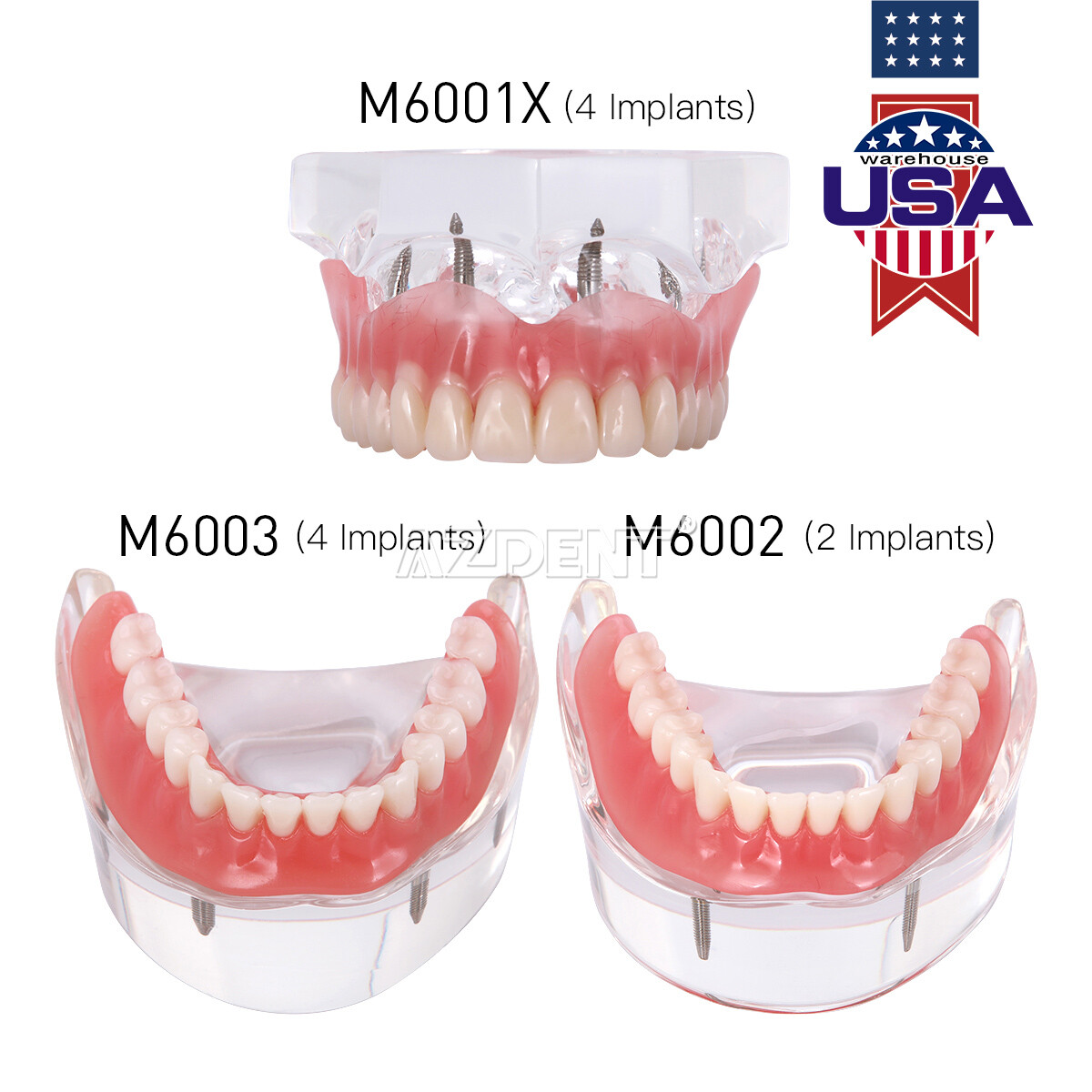 US Dental Implant Teeth Model Demo Overdenture Restoration With Implants U/L
