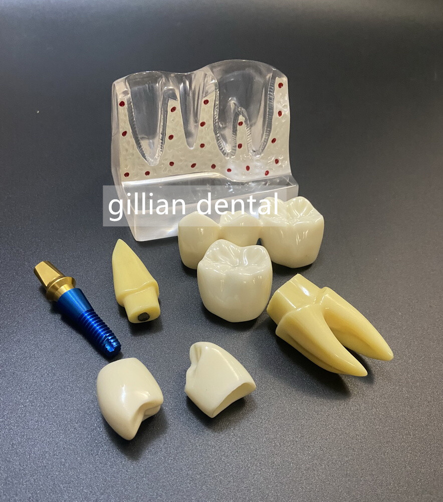 Dental Model Teeth Implant Restoration Bridge Teaching Study Medical Science