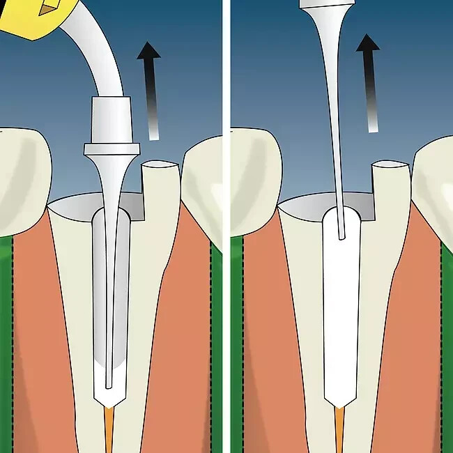 Kids-e-Dental E-IodoCal Calcium Hydroxide Paste