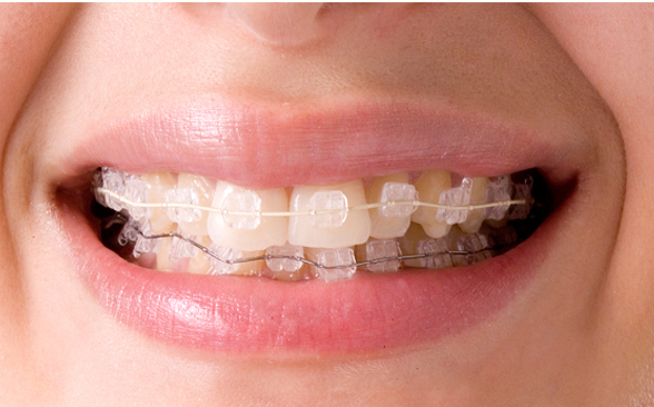 J&J Ortho™ CLARO™ Crystal Sapphire Orthodontic Bracket(20 Brackets) Hubit