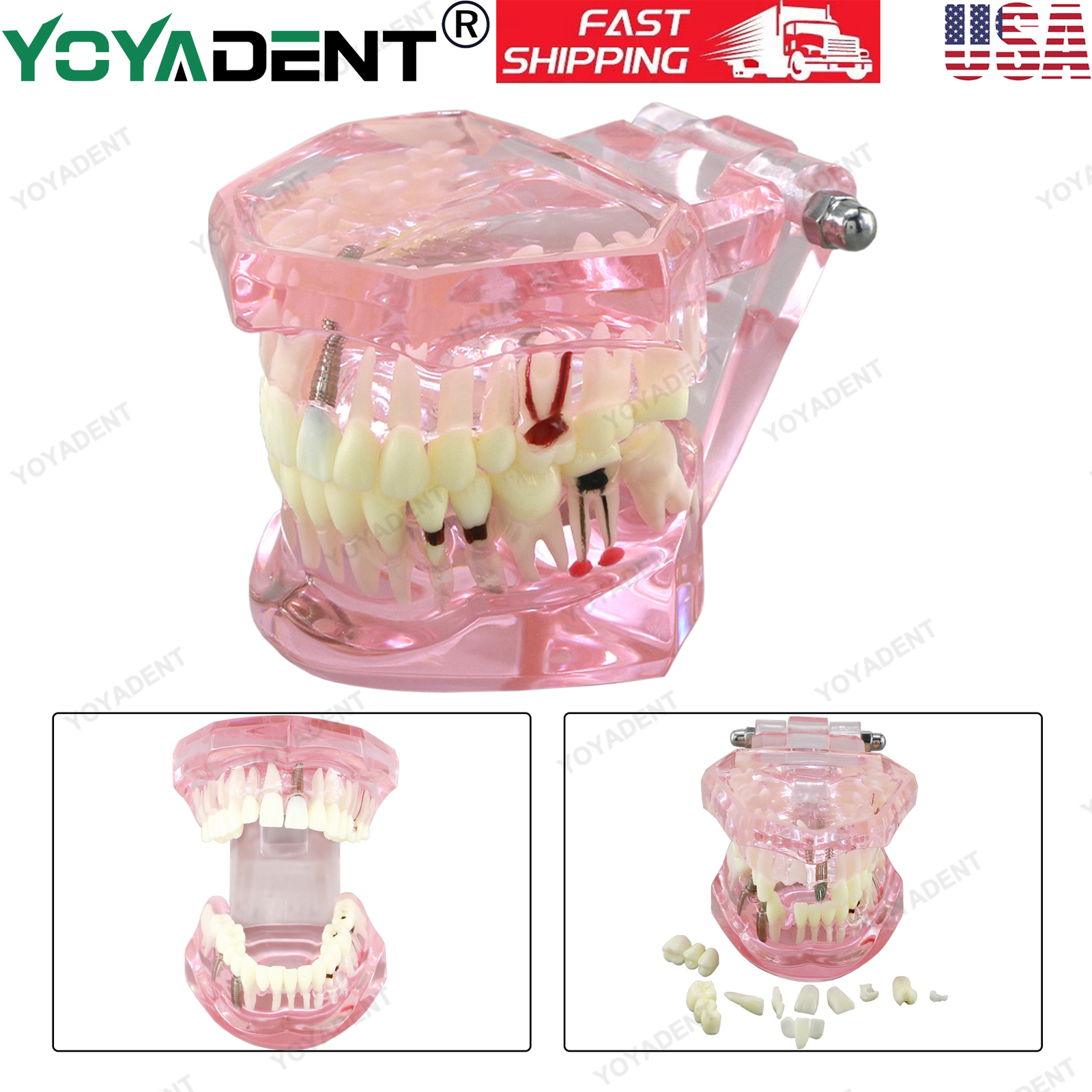 US Dental Teeth Model Ortho Implant Practice Teaching With Implants Demo Model