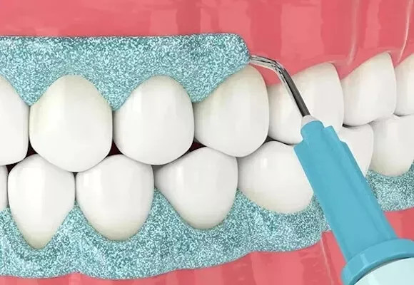 Maarc Blitz White Bleaching Kit 35 HP Based In-Office Tooth Whitening Kit.