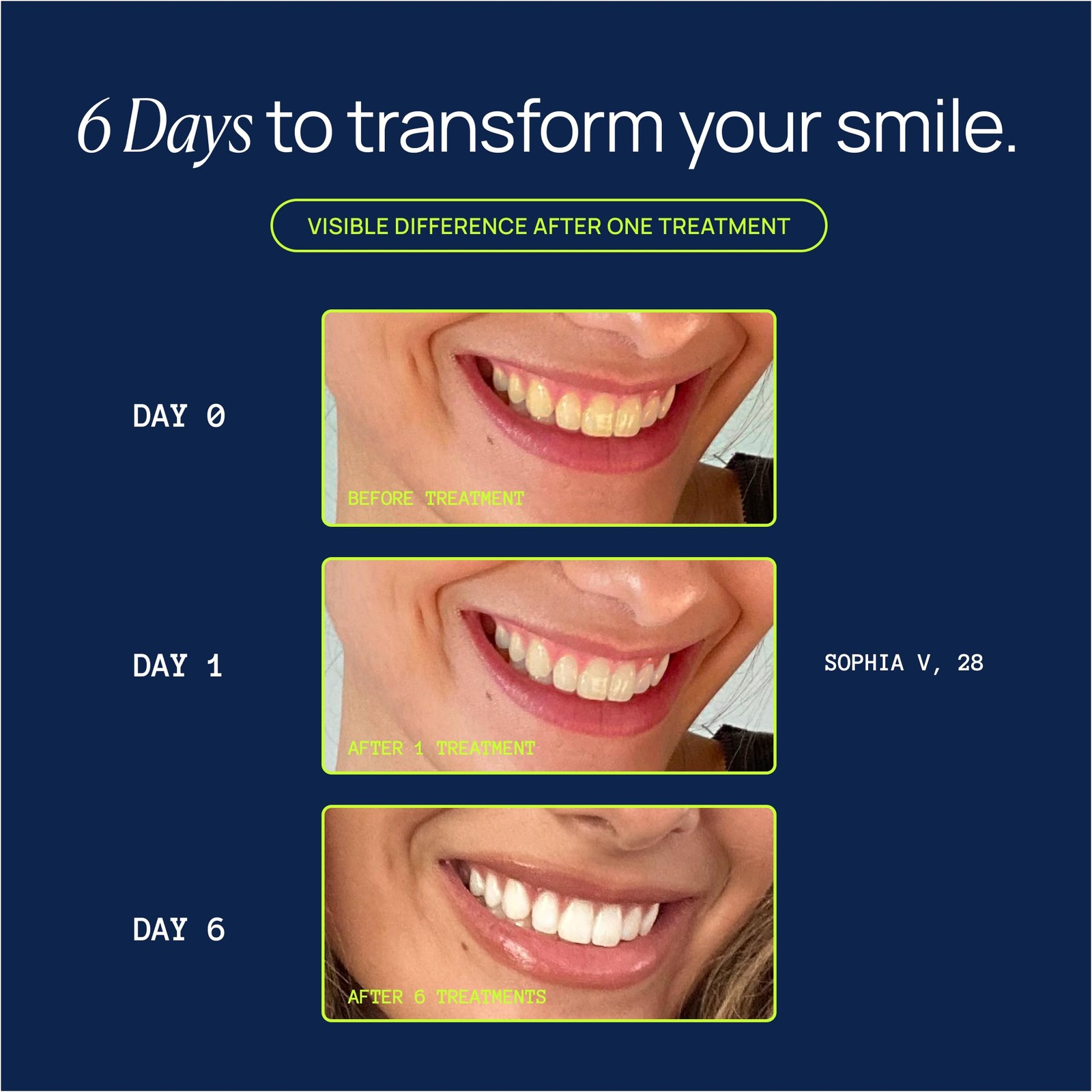 Laughland Super Strength Teeth Whitening Gel 3 Pack, 2.93 Fl Oz (Pack of 3)