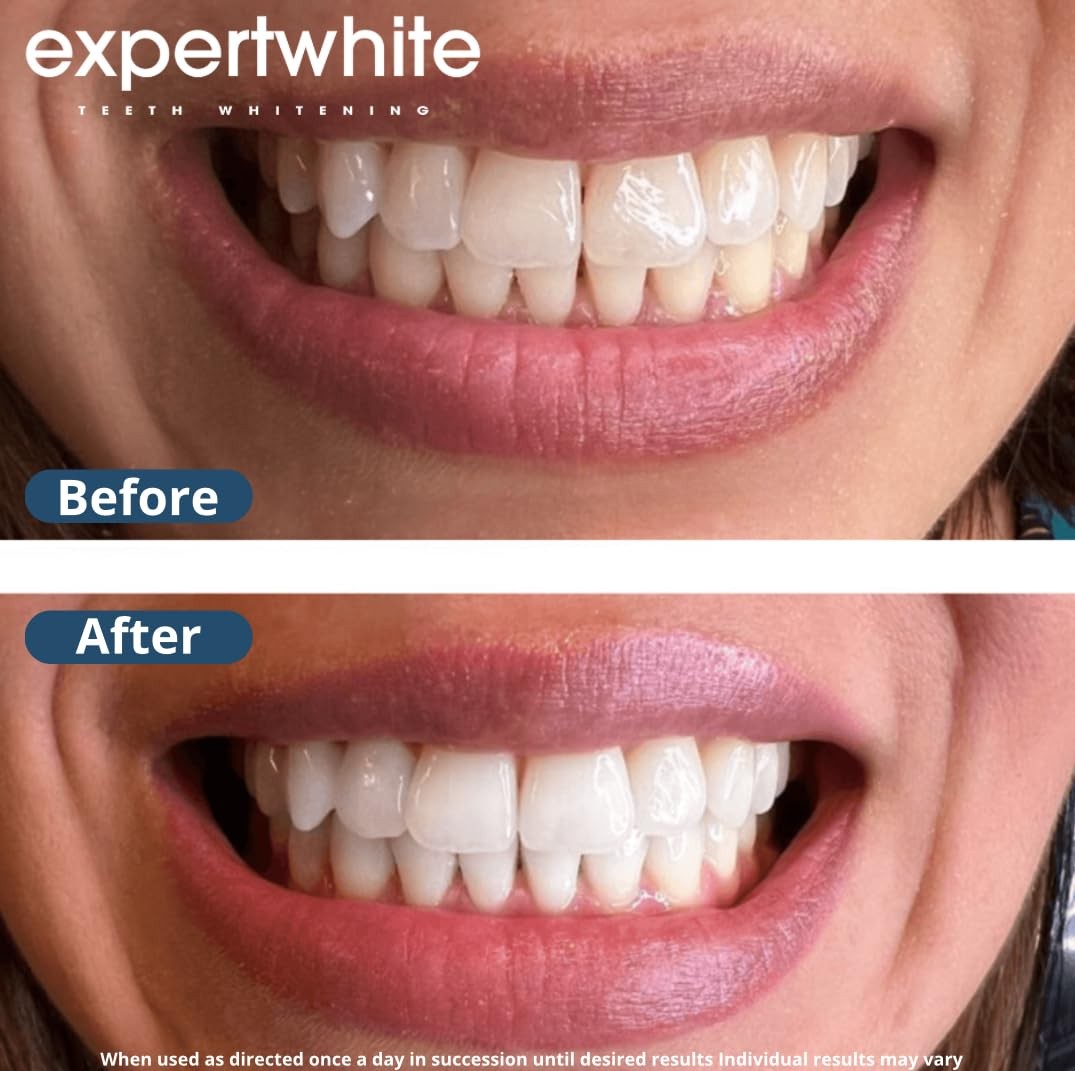Expertwhite Teeth Whitening Gel Refills (6-gels). Made 0.1 Fl Oz (Pack of 6)