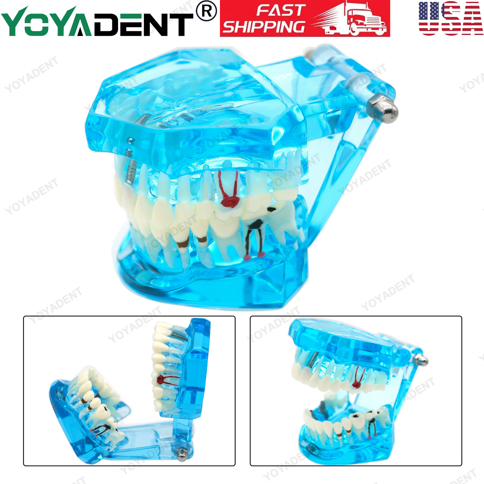 US Dental Teeth Model Ortho Implant Practice Teaching With Implants Demo Model
