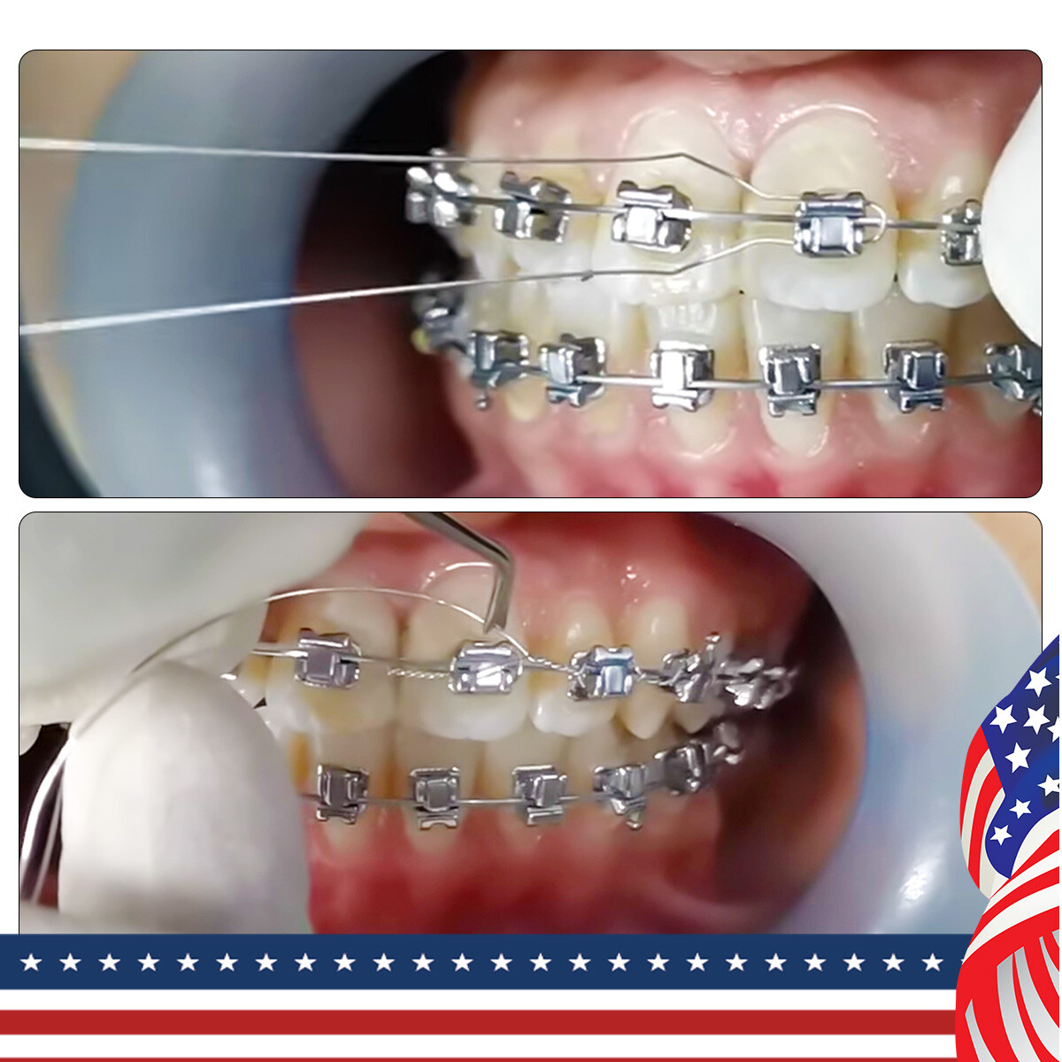 Dental Orthodontic Wire Preformed/Kobayashi Ligature Ties Stainless Steel AZDENT