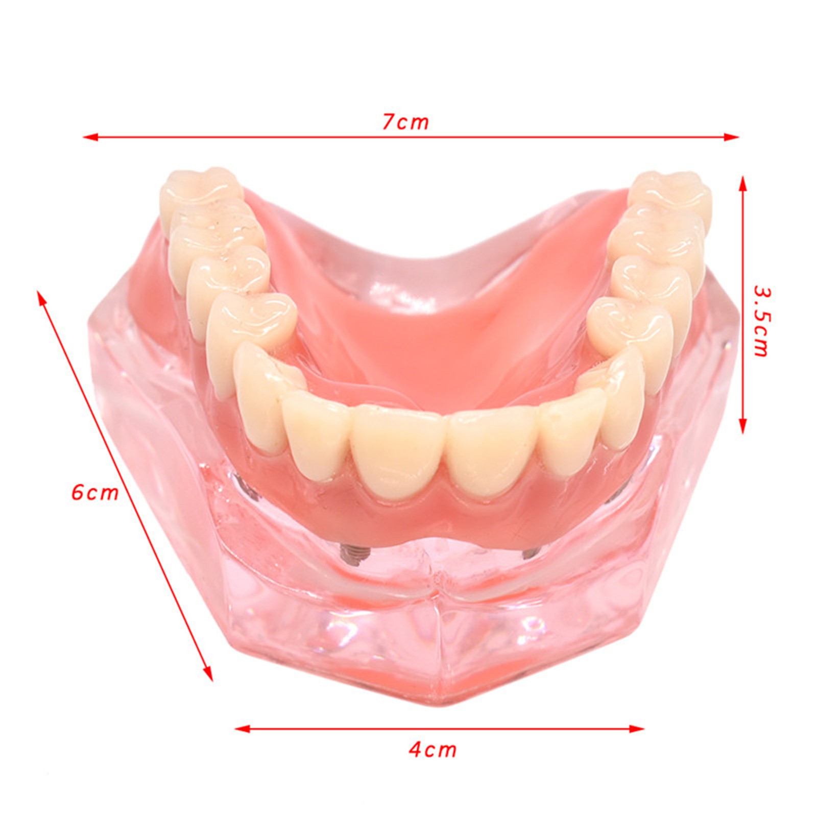 Dental Teeth Model Upper Lower Tooth 4 Implants Restoration Overdenture Model