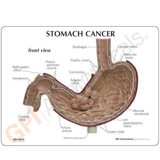 Stomach Cancer GPI Anatomical Model LFA #2001. Make Us an Offer! SEE VIDEO