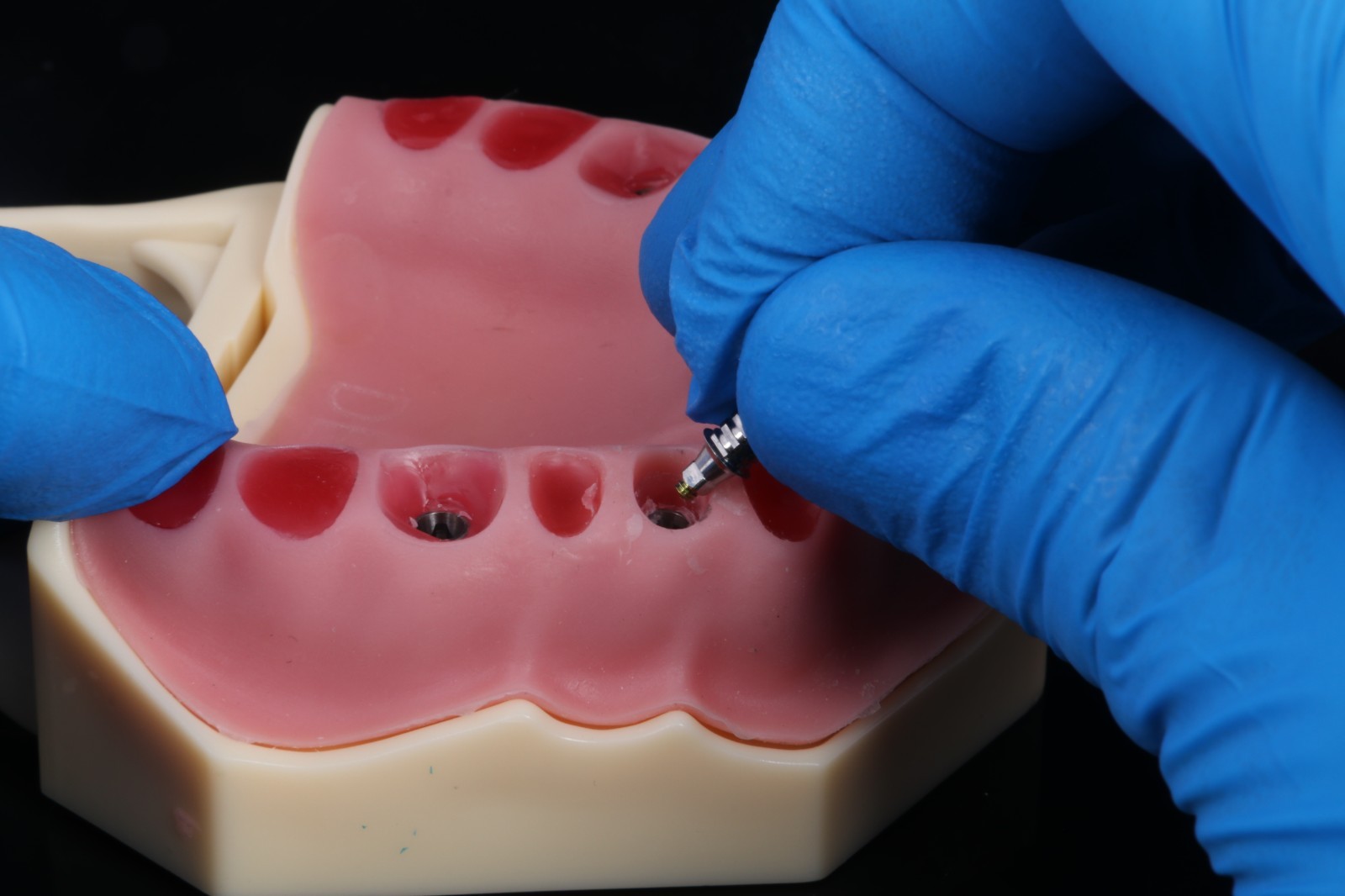 Natural Emergence Profiler, Dental Implant,Dental Laboratory,Dentistry