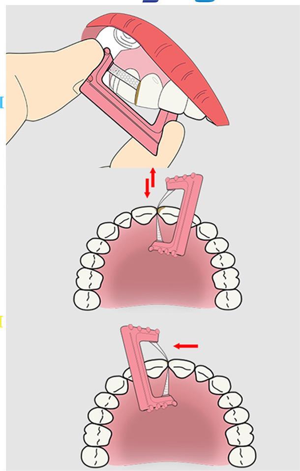 Dental Orthodontic IPR Reduction Strip Polishing saw Interproximal Enamel Strips
