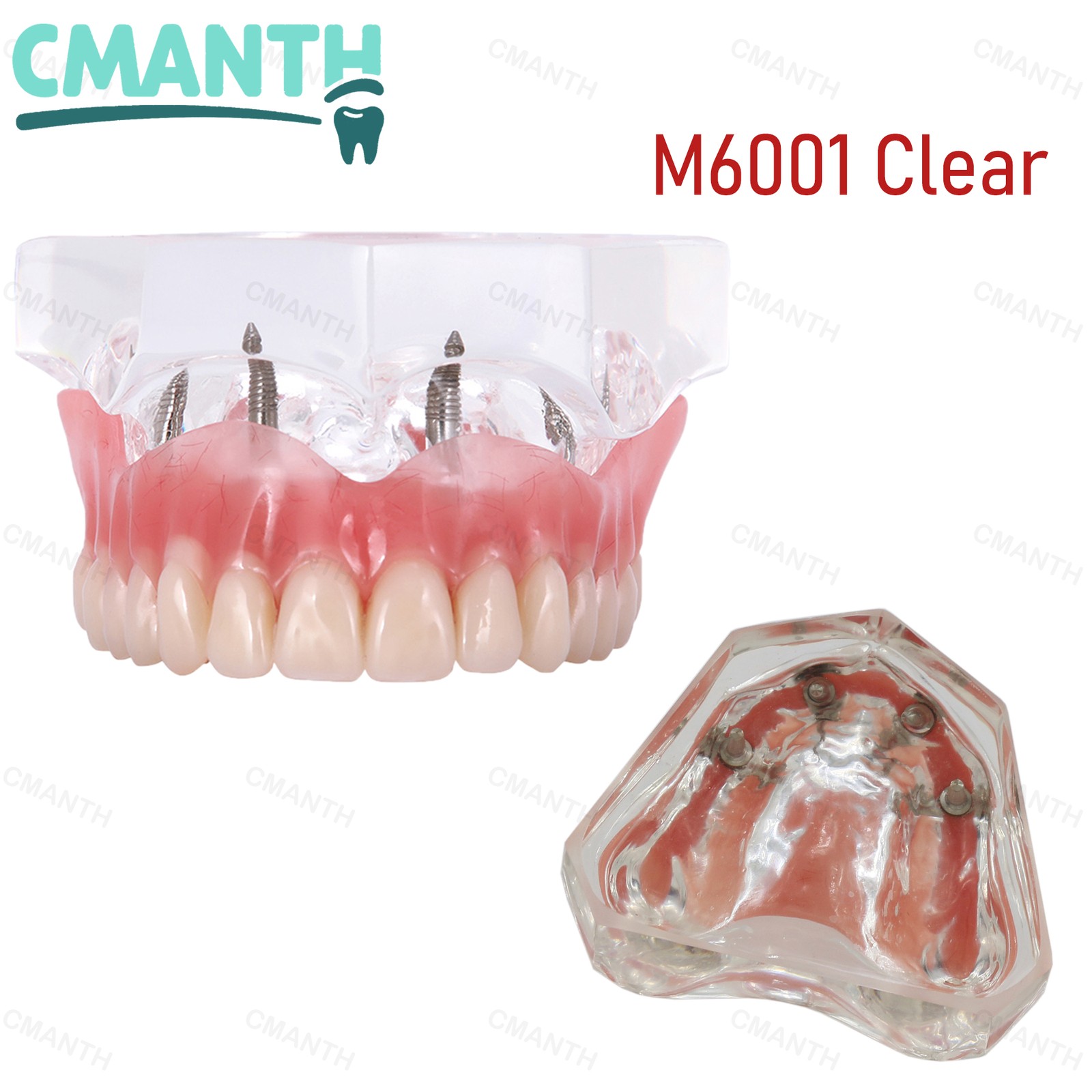 Dental Teeth Model Upper Lower Tooth 4 Implants Restoration Overdenture Model