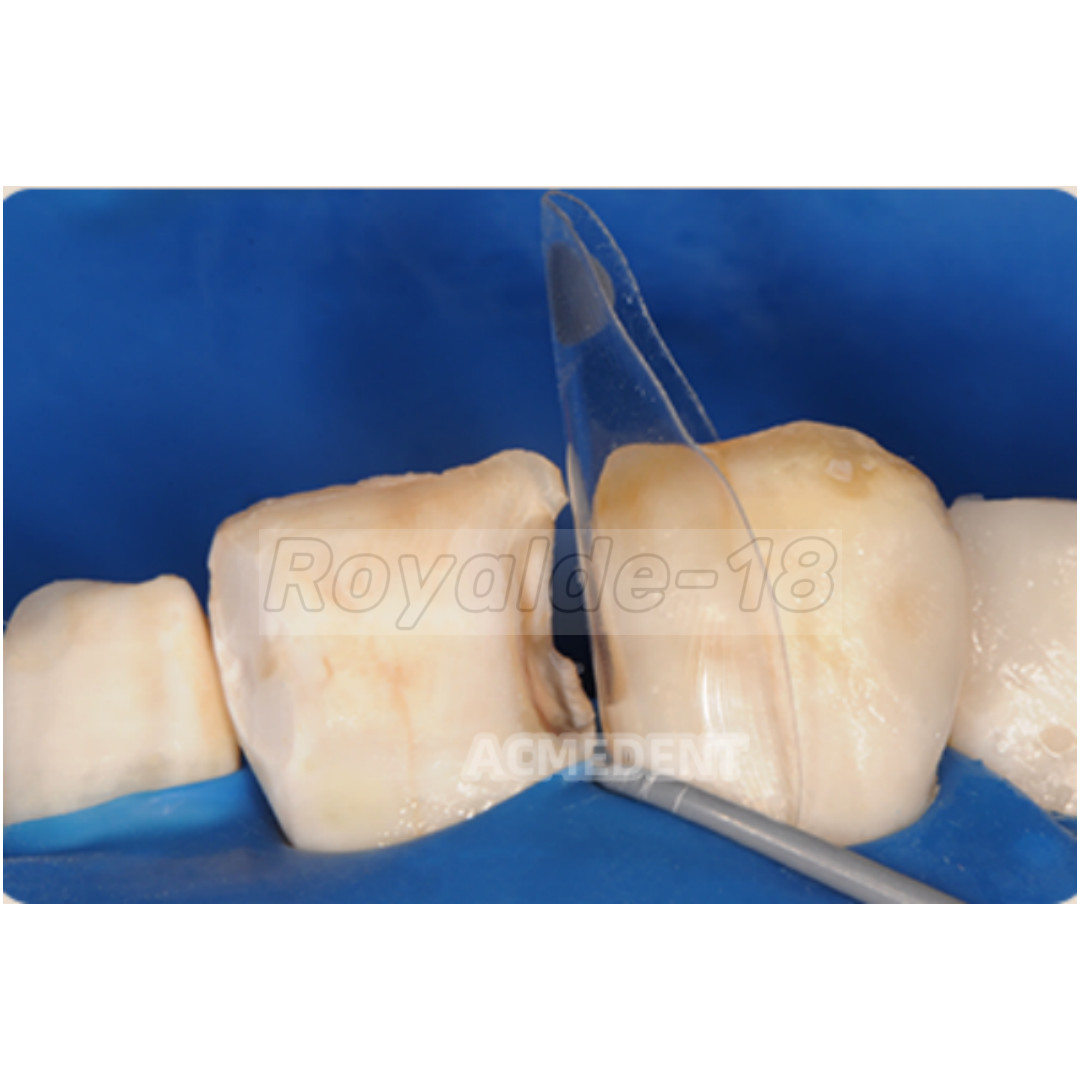 1Box Dental Clear Matrix BT Matrices Black Triangle Wedge Diastema Fits BioClear