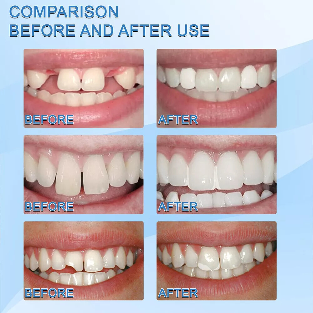 Resin False Teeth Solid Glue Temporary Tooth Repair Moldable Teeth Gap Denture
