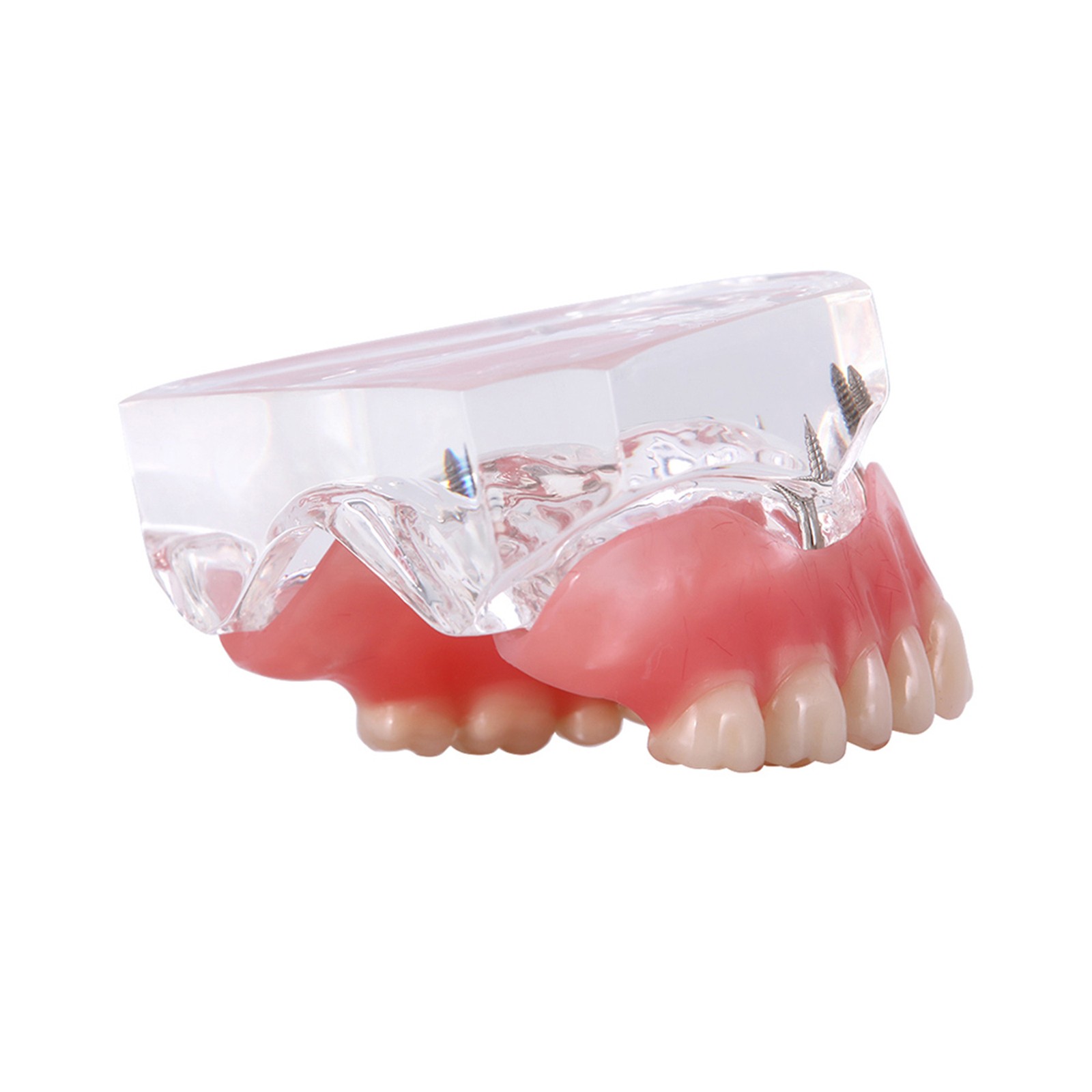 Dental Teeth Model Upper Lower Tooth 4 Implants Restoration Overdenture Model
