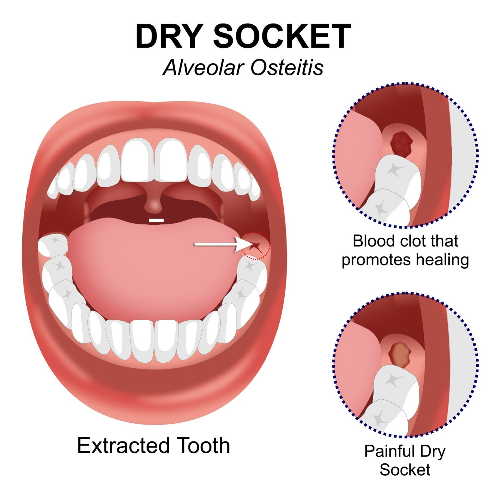Ora-Aid 4 single-use packs | Self-Adhesive Intraoral Wound Dressing