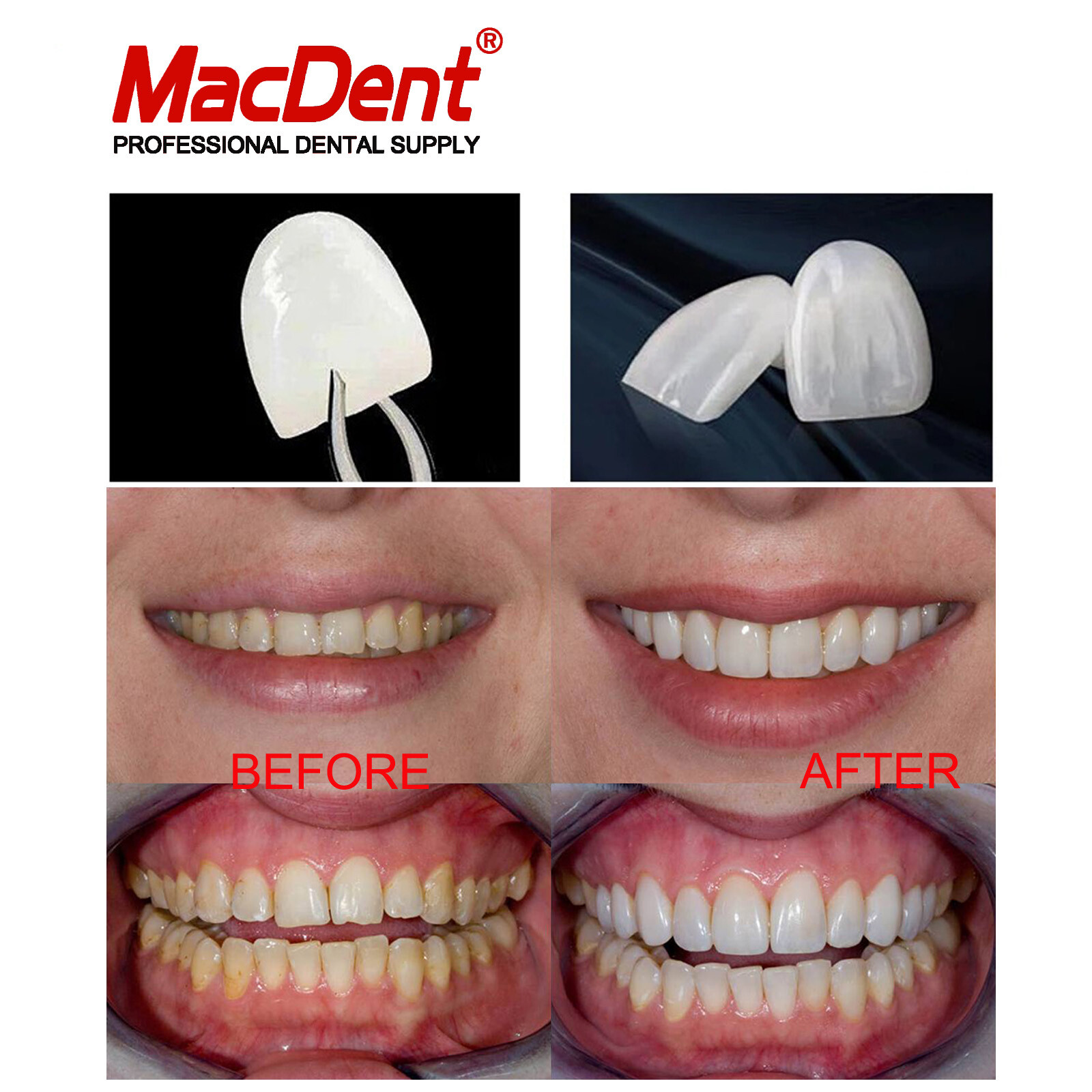 30Size Dental Composite Porcelain Veneers Resin Light Cure Anterior Teeth Veneer