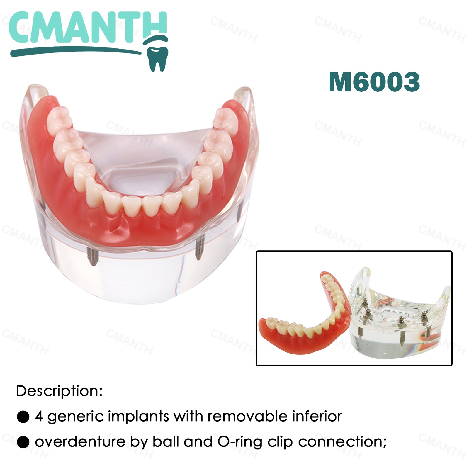 Dental Teeth Model Upper Lower Tooth 4 Implants Restoration Overdenture Model