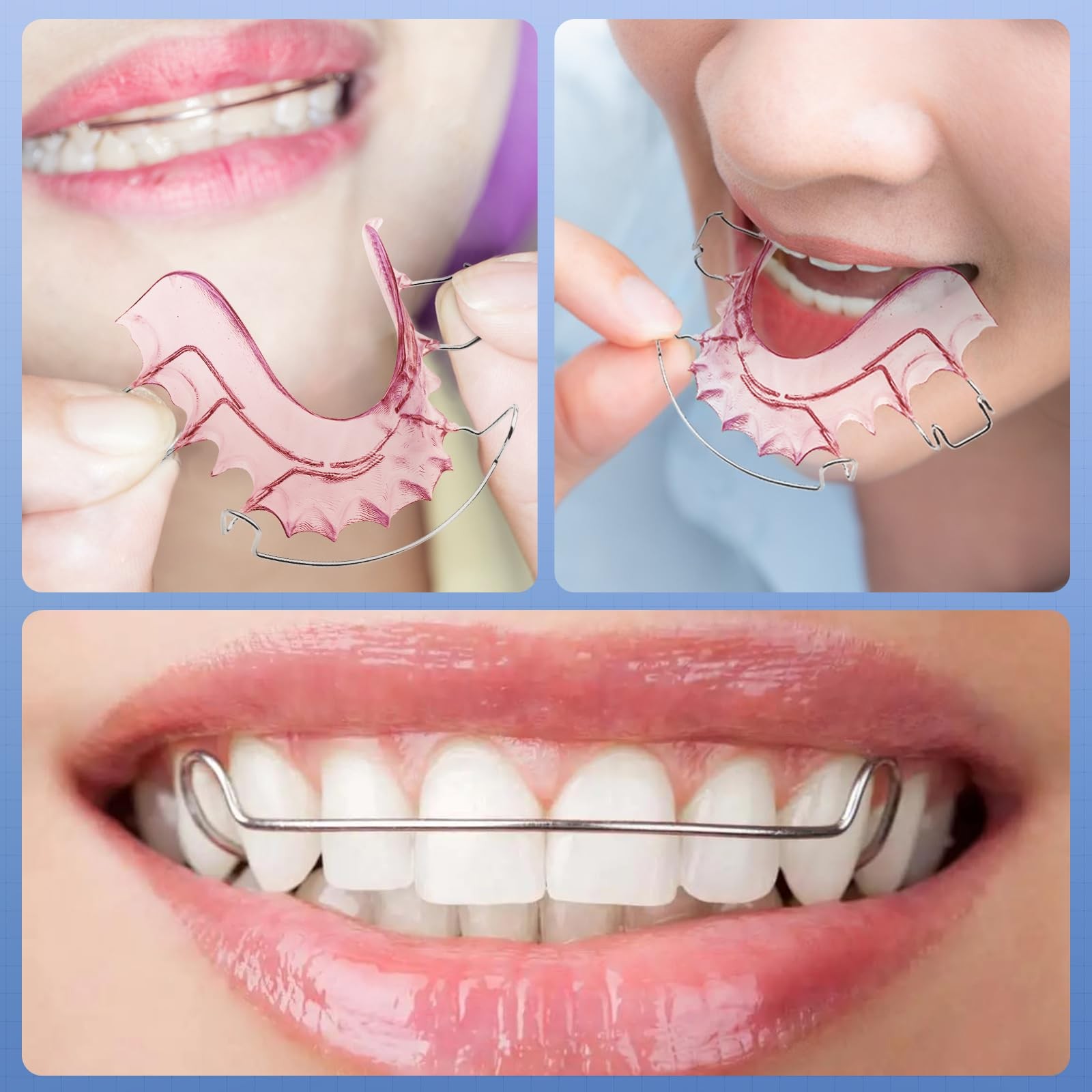 2 Hawley Retainers for Custom Teeth Retention