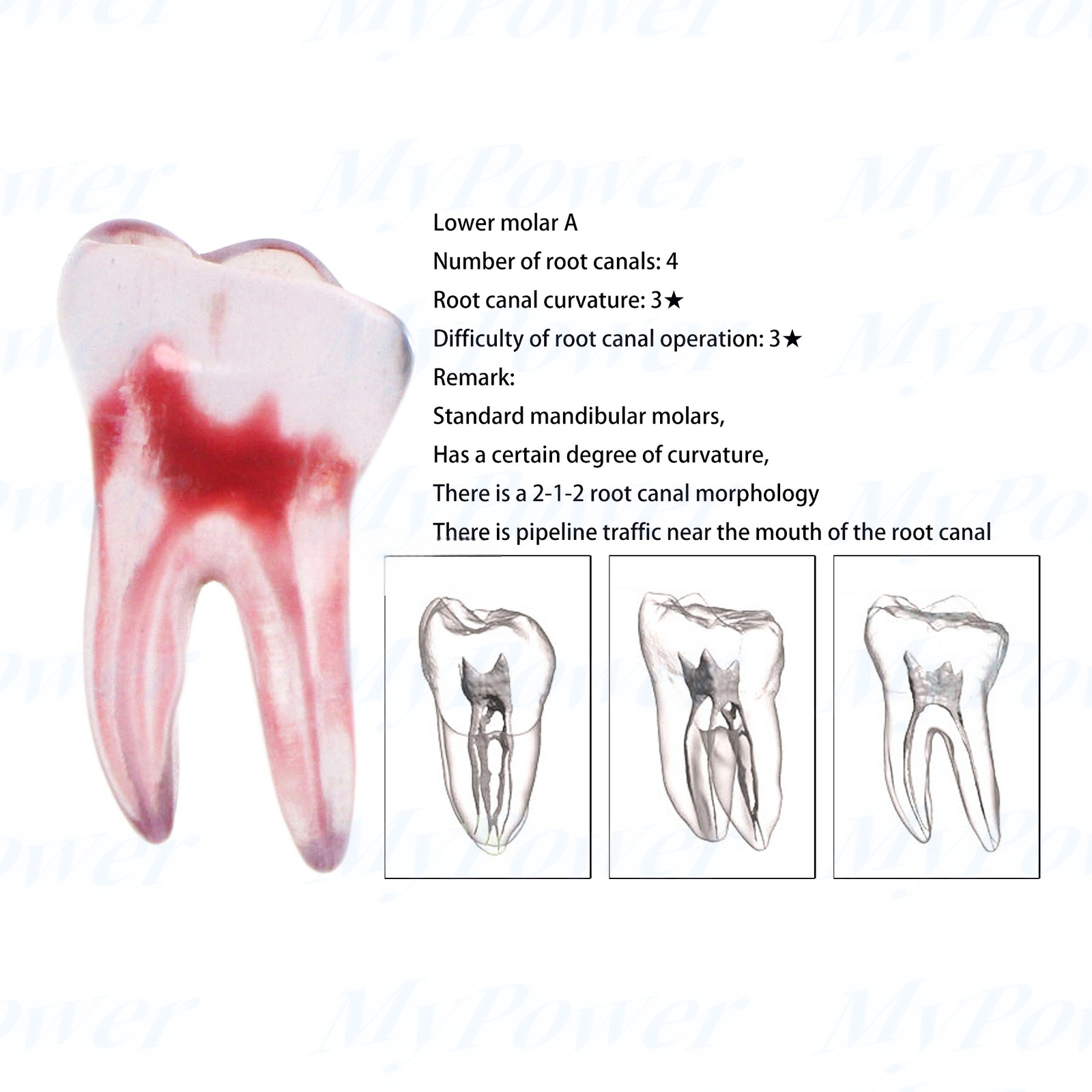 Dental Training 3D RCT Endo Tooth Model Practice Model Curved Root Resin Teeth