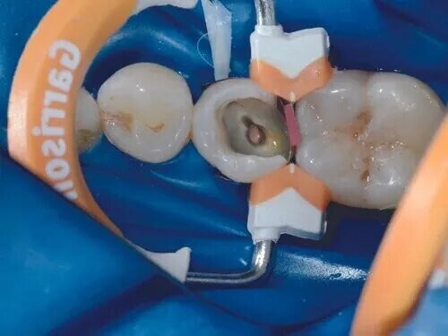 Garrison Dental Composi-Tight 3D Fusion Matrix Rings,Free Shipping