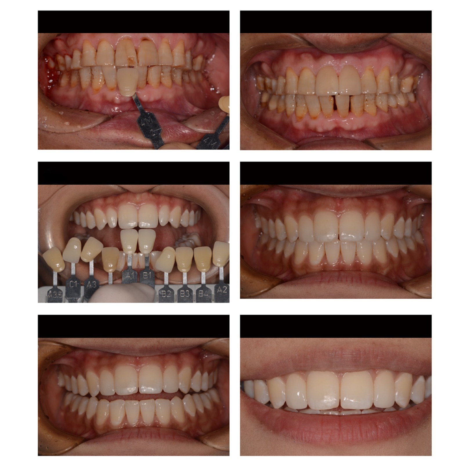 Dental Emax Lithium Disilicate Blocks C14 CAD/CAM CEREC Inlab Chairside System