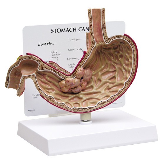 Stomach Cancer GPI Anatomical Model LFA #2001. Make Us an Offer! SEE VIDEO