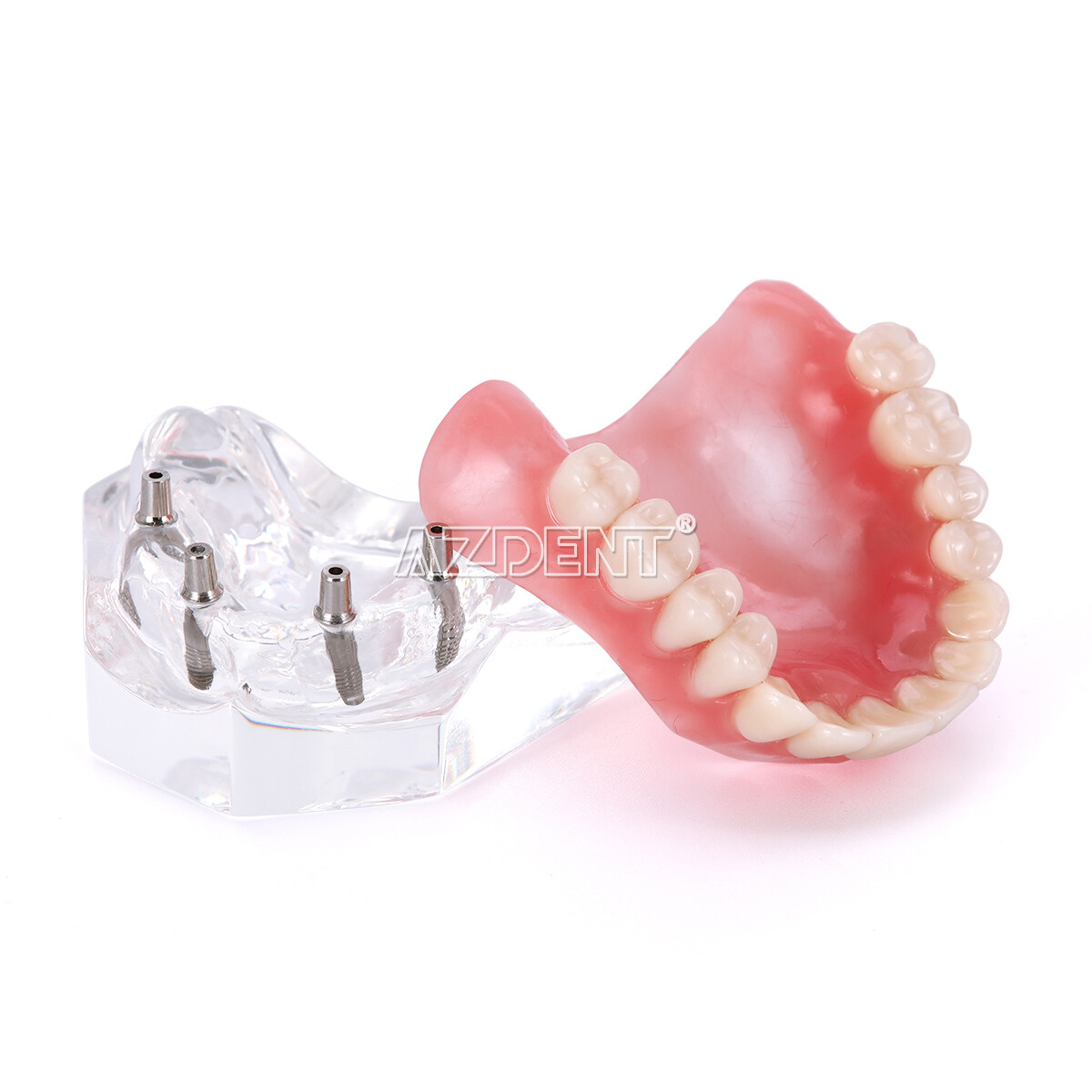Dental Implant Teeth Model Demo Overdenture Restoration with Implants U/L 2 4