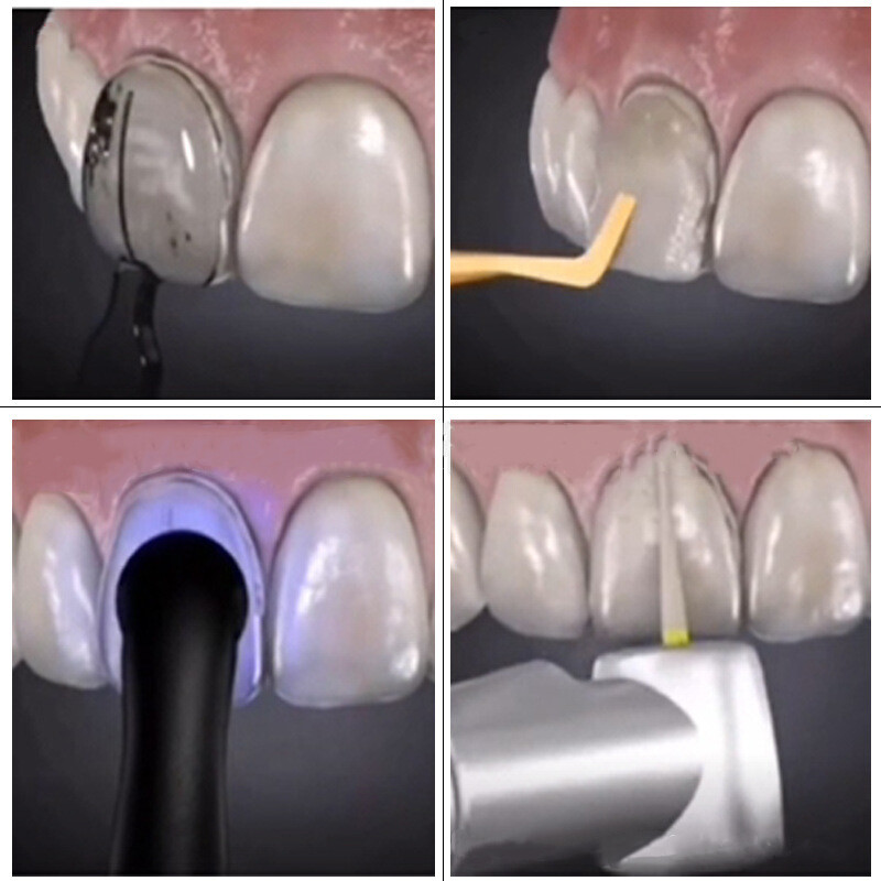 30pcs Dental Composite Resin Veneers Mould Light Cure Anterior Front Teeth USA