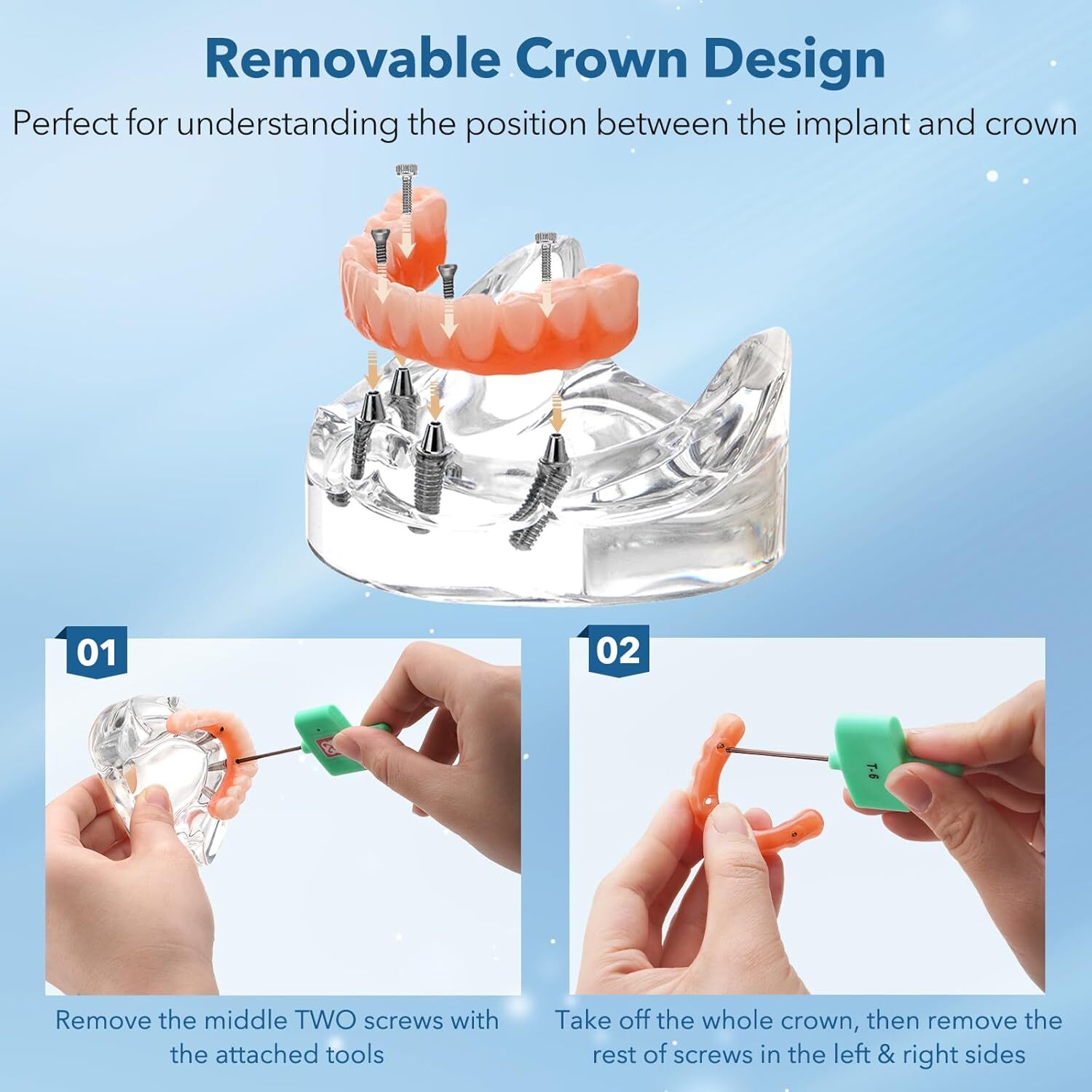 Dental Implant All-on-4 Overdenture Treatment Model Upper/Lower 4 Implants Clear