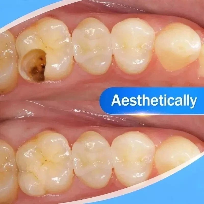 Dental Cement Resin Filling Materials Dentistry Denfil Syringe Universal Teeth