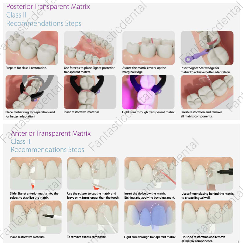Dental Transparent Matrix Clear Bow Matrice Band Anterior Front Bioclear TorVM