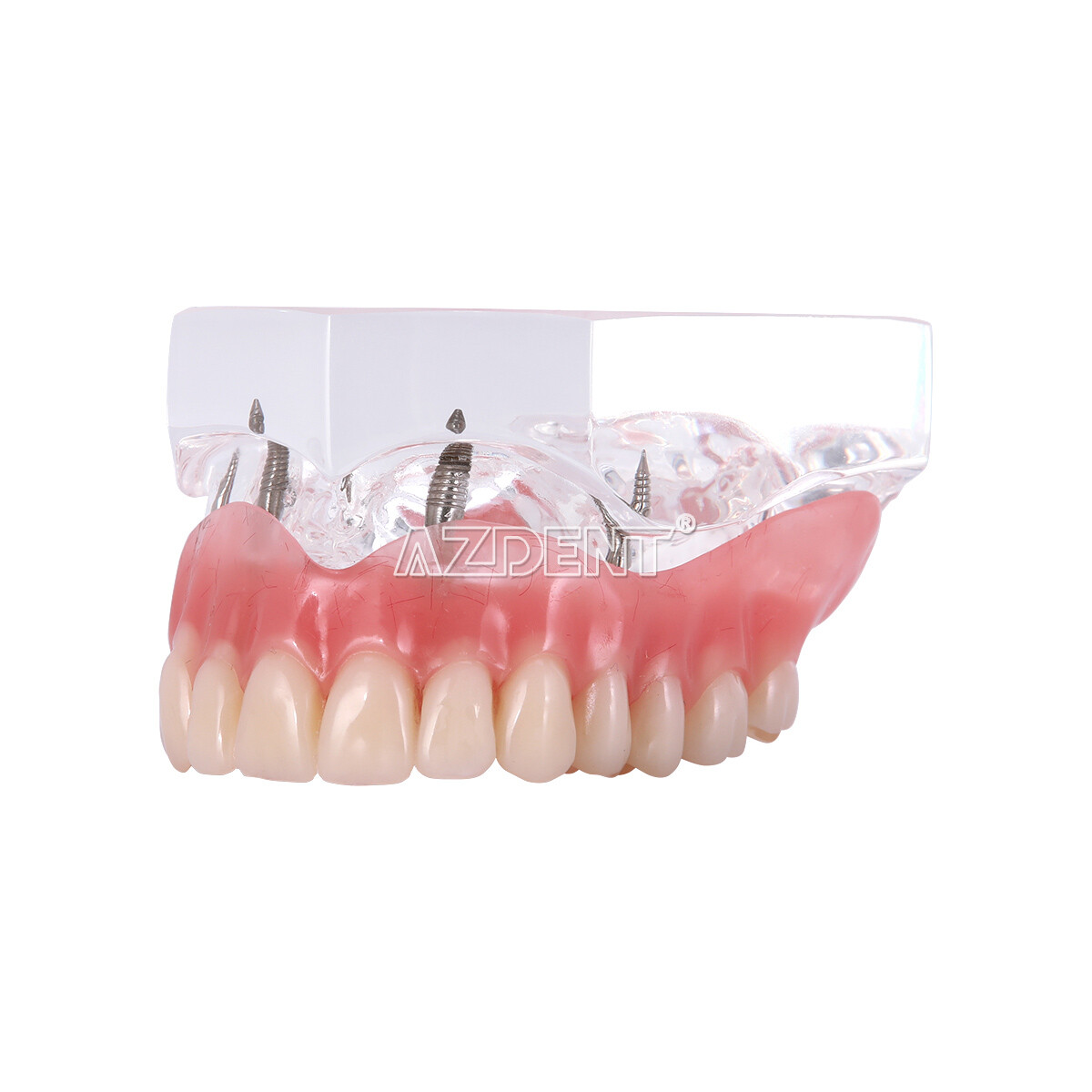 Implante dental Dientes Modelo Demo Sobredentadura Restauración 2/4 Implantes