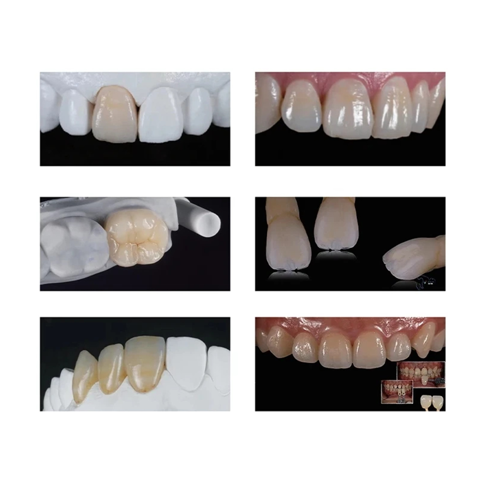 Dental Emax Glass Ceramic Blocks C14 CAD/CAM Lithium Disilicate CEREC Block 5PCS