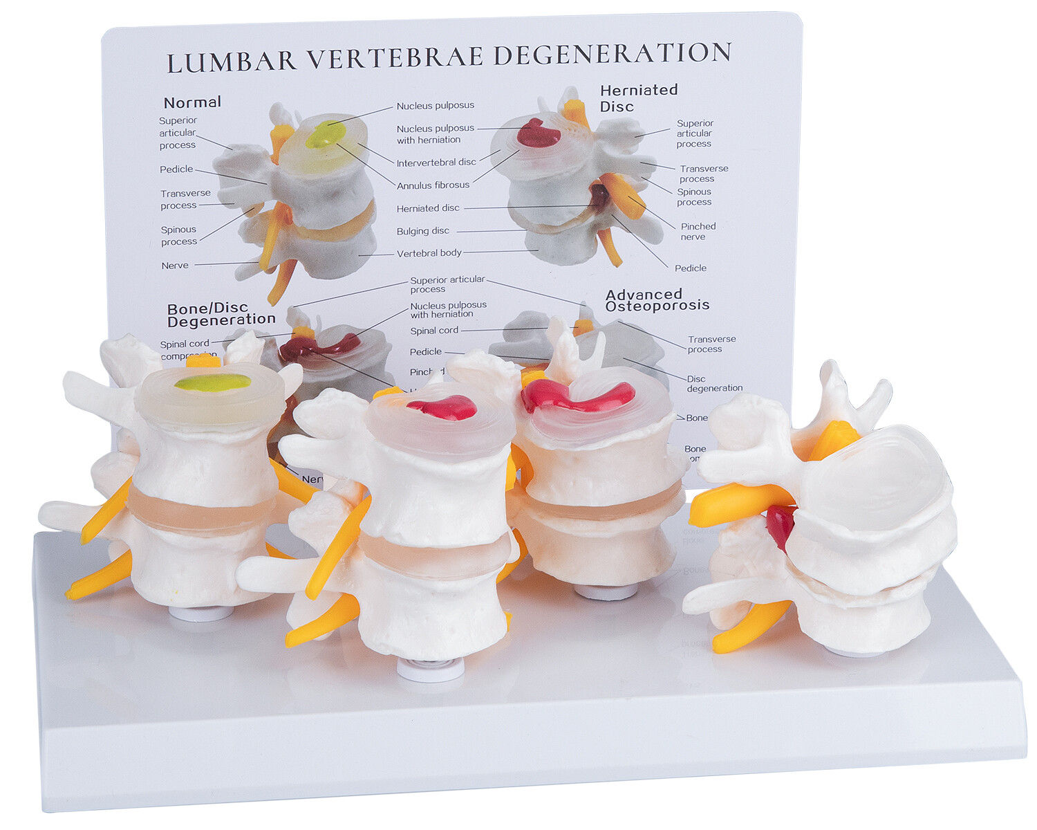 Pathological Human Lumbar Spine Anatomy Model 4-Stage Medical Science Teaching