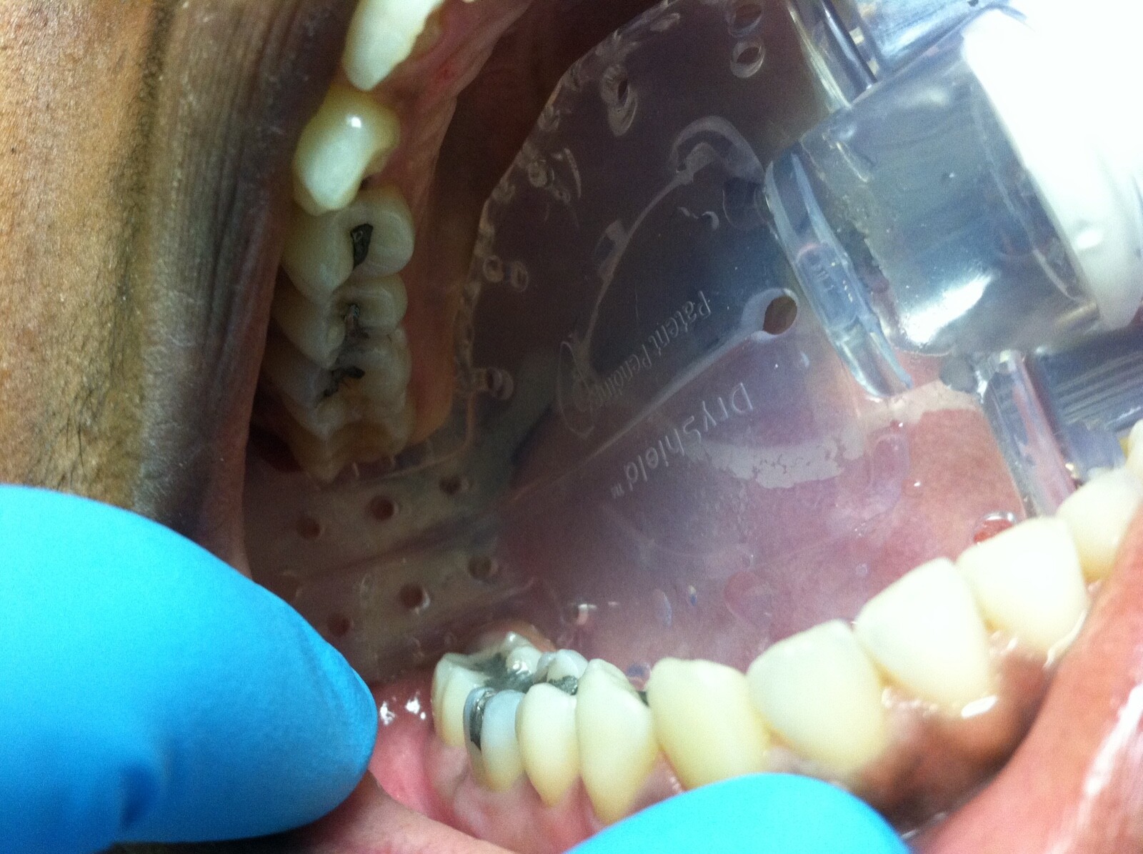 REDUCE DENTAL AEROSOLS; AUTOCLAVABLE 2 MEDIUM DRYSHIELD ISOLATION MOUTH PIECES