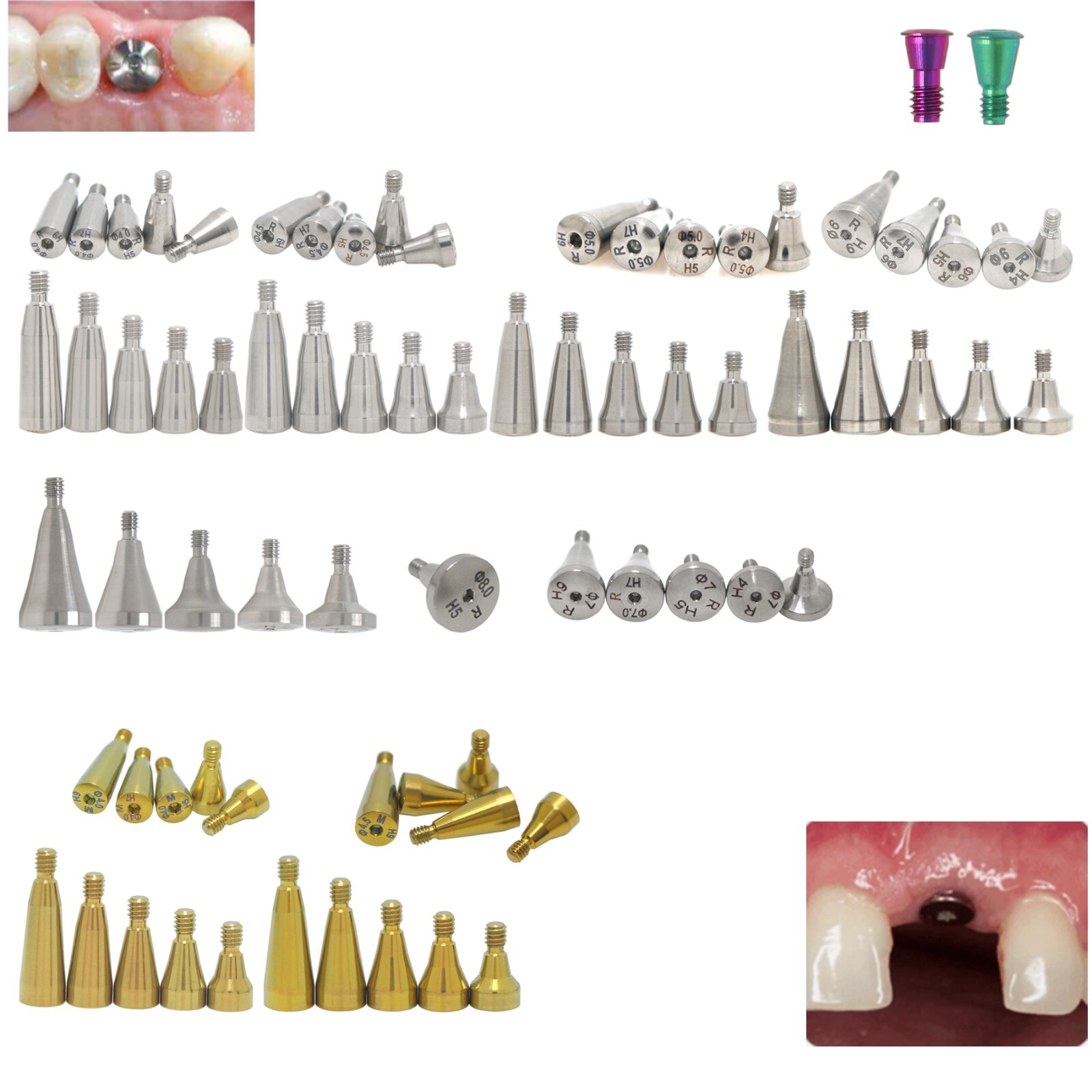 US Hiossen osstem Hex platform fits Regular/Mini Locator/Healing Abutment Analog