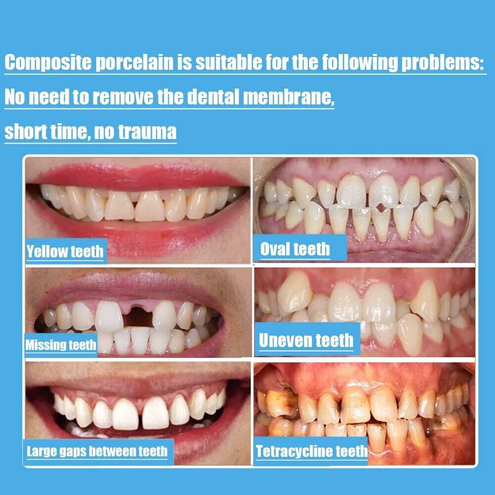 30Size Dental Composite Porcelain Veneers Resin Light Cure Anterior Teeth Veneer