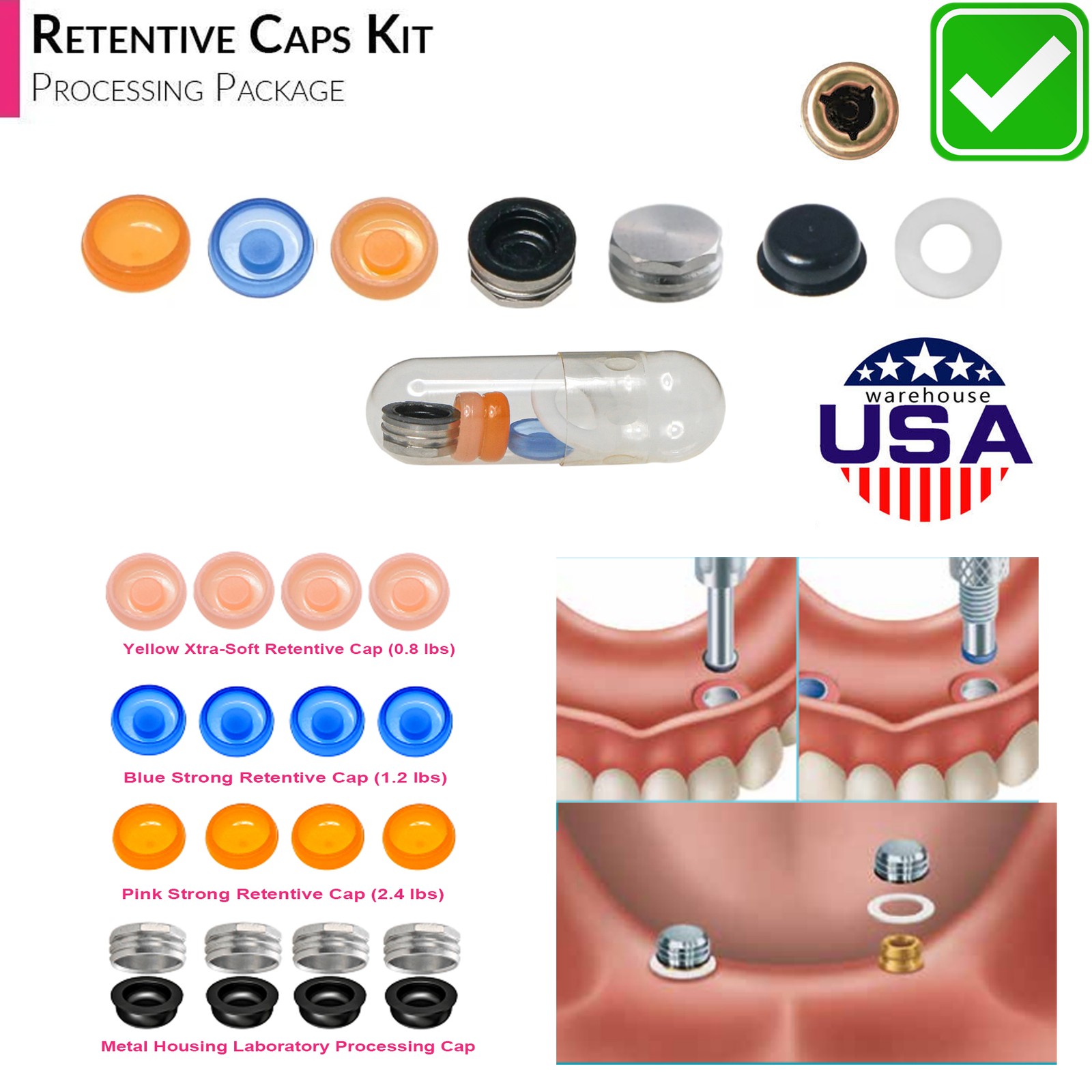 US Dental Locator Overdenture Abutment & Caps Fits Nobel/Hiossen/Zimmer/MIS/TSV