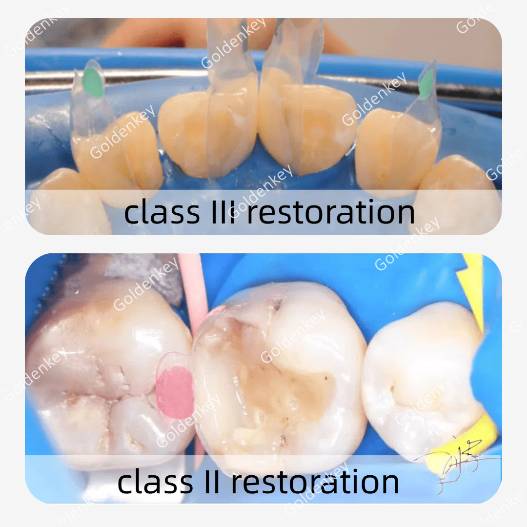 Clear Matrix Dental Anterior Posterior Transparent BT Matrices Fit BioClear