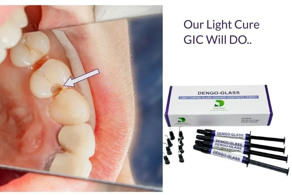 Dengen Dental Dengo-Glass Light Curing Glass Ionomer (4 x 2gm)