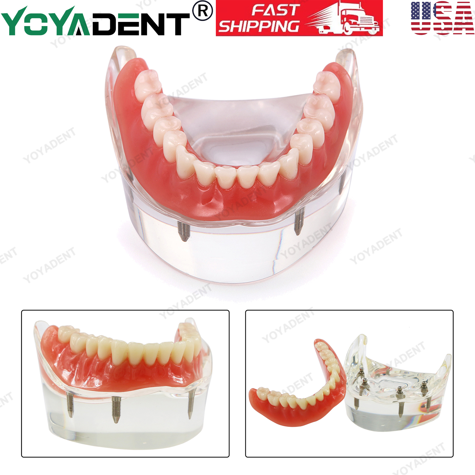 US Dental Teeth Model Ortho Implant Practice Teaching With Implants Demo Model