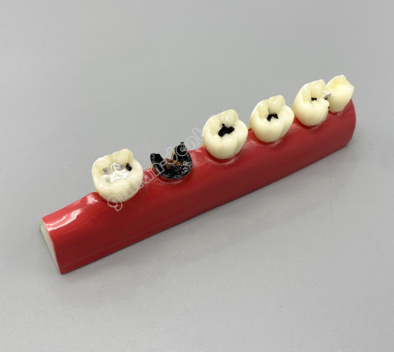 Dental Model Teeth Implant Restoration Bridge Teaching Study Medical Science