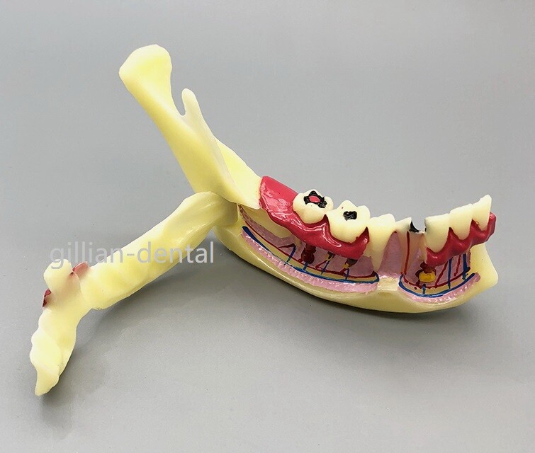 Dental Model Teeth Implant Restoration Bridge Teaching Study Medical Science