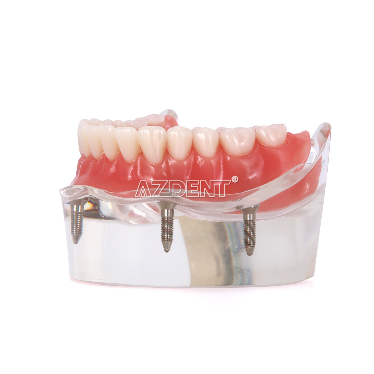 Dental Implant Teeth Model Demo Overdenture Restoration with Implants U/L 2 4