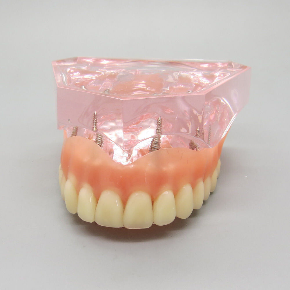 Dental High Quality Model of Upper Teeth Dentures Superior 4 Implants Maxillary