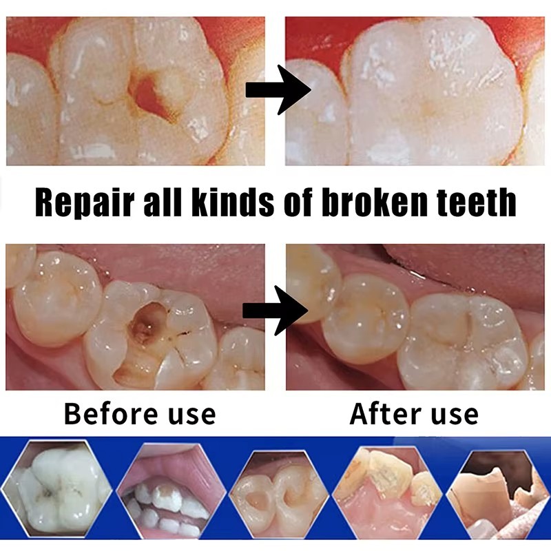 Dental Cement Permanent Tooth Filling Fixation Powder Liquid resin glue teeth